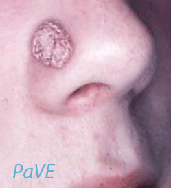 full image of PaVE HPV2 Cubie 6 large.png