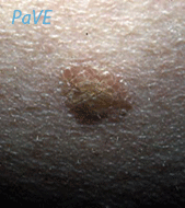 full image of PaVE HPV5 Cubie 1 large.png